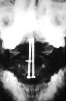 AP Dens Screws.