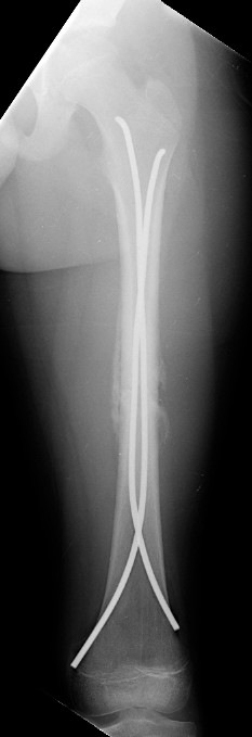 AP Femur Callus Small.