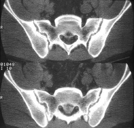 ASCT SI erosions.