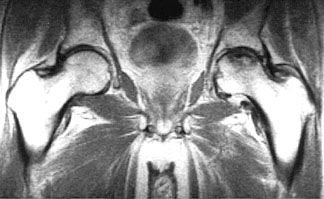AVN Coronal MR.