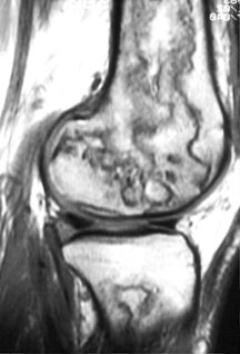 AVN Sag MR Knee.