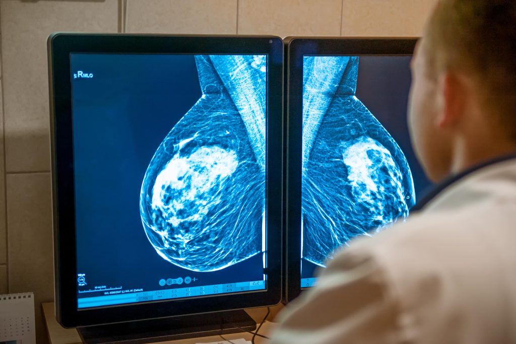 Mammogram.