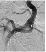 Arterial fluoroscopy.