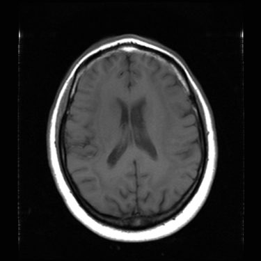 Axial T1 Noncontrast.