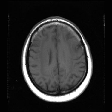 Axial T1 Noncontrast.