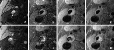 Carotid Artery Ulceration.