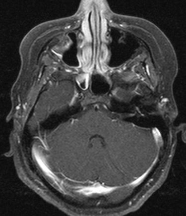 T1 axial post Gad.