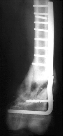 Blade Plate Femur.