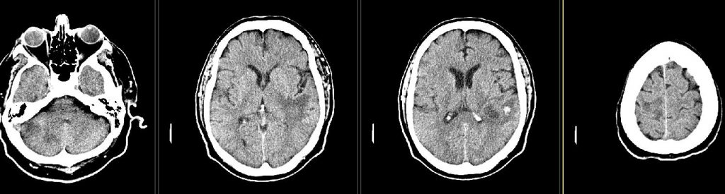 CT noncontrast