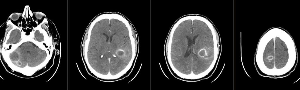 CT postcontrast