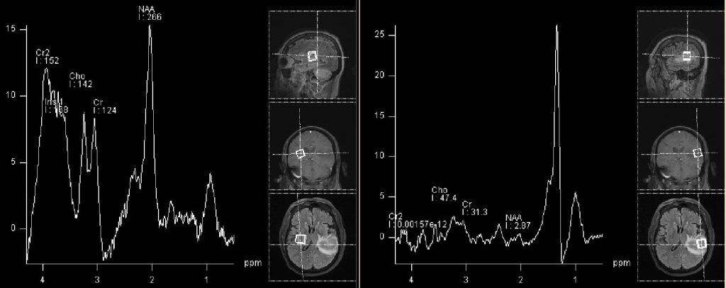 MR spectroscopy single voxel: control right brain