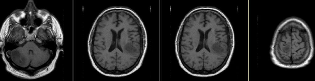 T1 noncontrast (Gad not given due to renal disease)