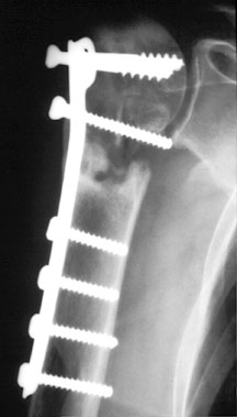 Buttress Plate.