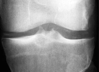 CPPD Knee.