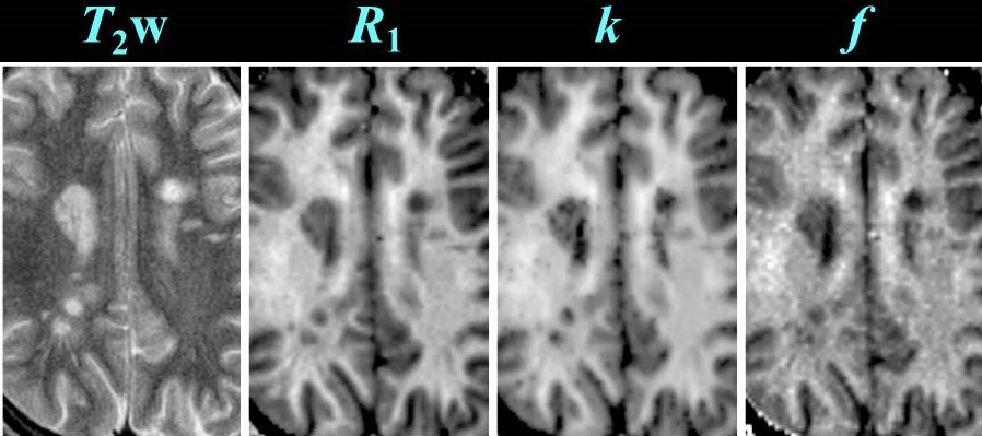 Cross relaxation imaging in multiple sclerosis.