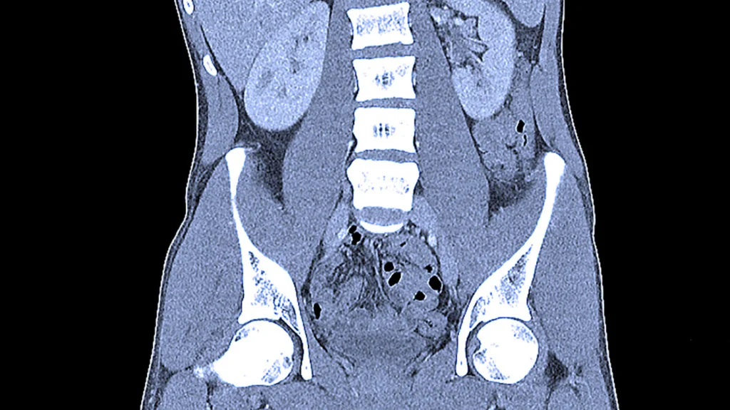 CT of a normal abdomen and pelvis.
