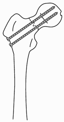 Cannulated Femur.