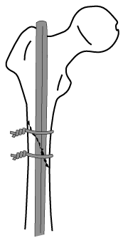 Cerclage Wires.