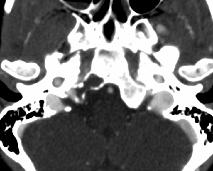 CT axial postcontrast soft tissue windows.