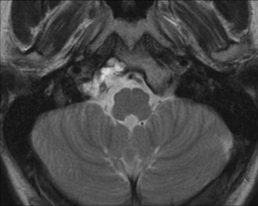 Axial noncontrast T2.