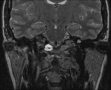 Coronal T2 fat sat.