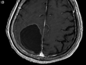 Axial postcontrast.
