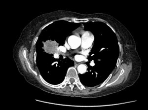 Metastasis from squamous cell carcinoma of lung.
