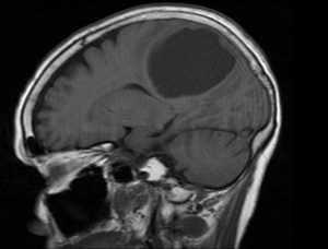 T1 sagittal noncontrast.