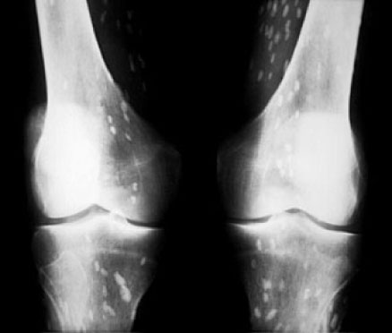 Cysticercosis Knees.
