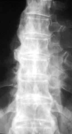 DDDAPT Spine.