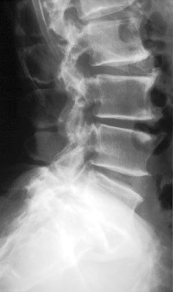 Lateral spine xray.