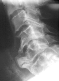 DISH Lat C Spine.