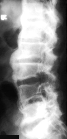 DISH Lat L Spine.