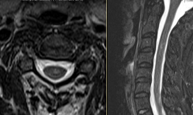 Cervical spine T2 axial and sagittal STIR.