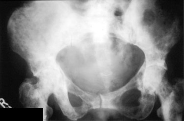 Pelvis Xray.