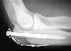 Elbow Tension Band.