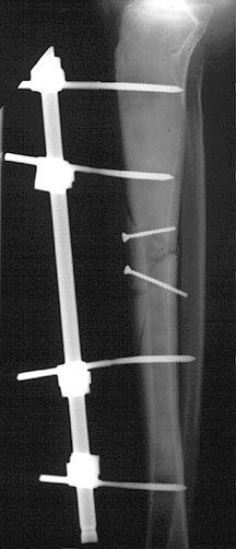 External Fix Tibia.