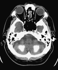 CT noncontrast