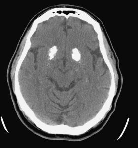 CT noncontrast