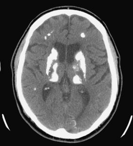CT noncontrast