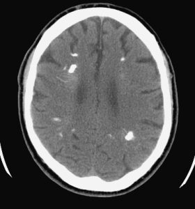 CT noncontrast