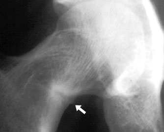 Femur Looser Detail.