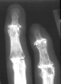 Fingers APOA.