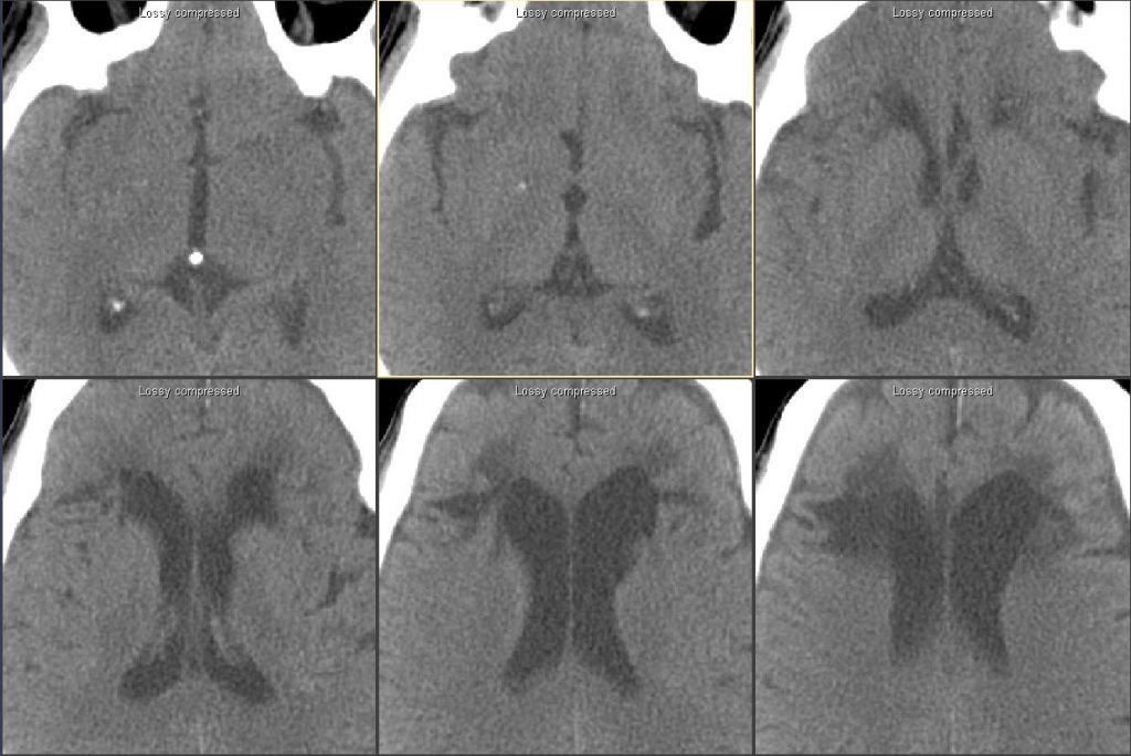 CT noncontrast.