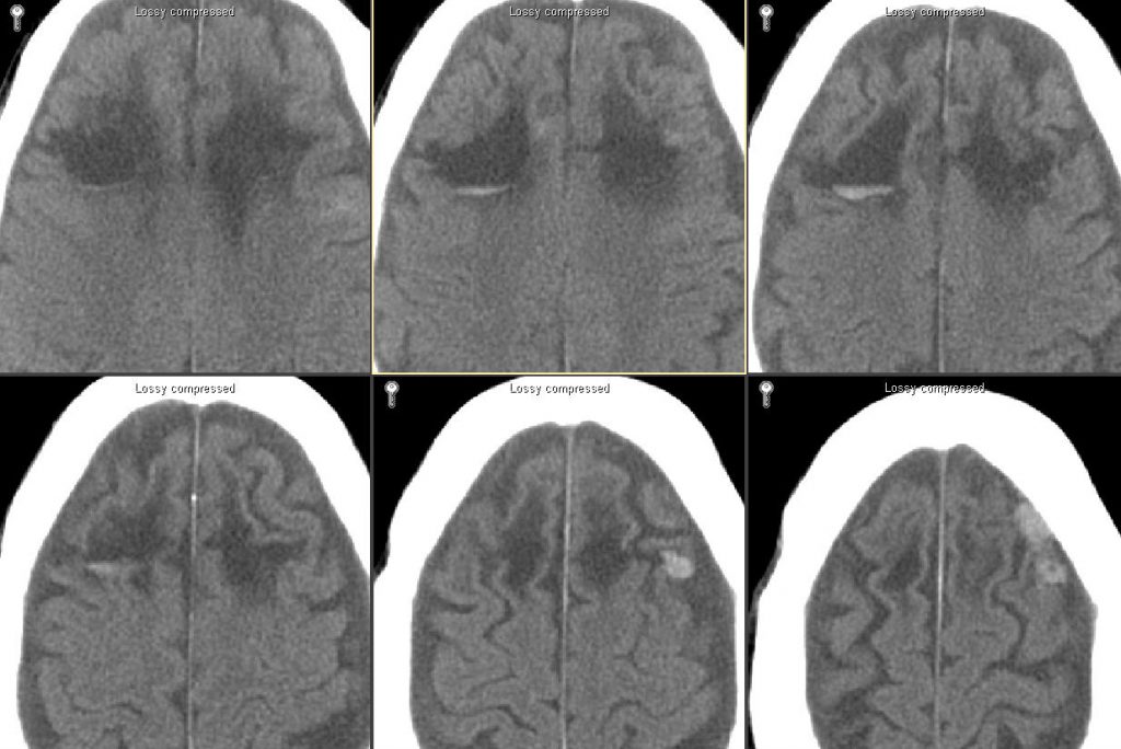 CT noncontrast.