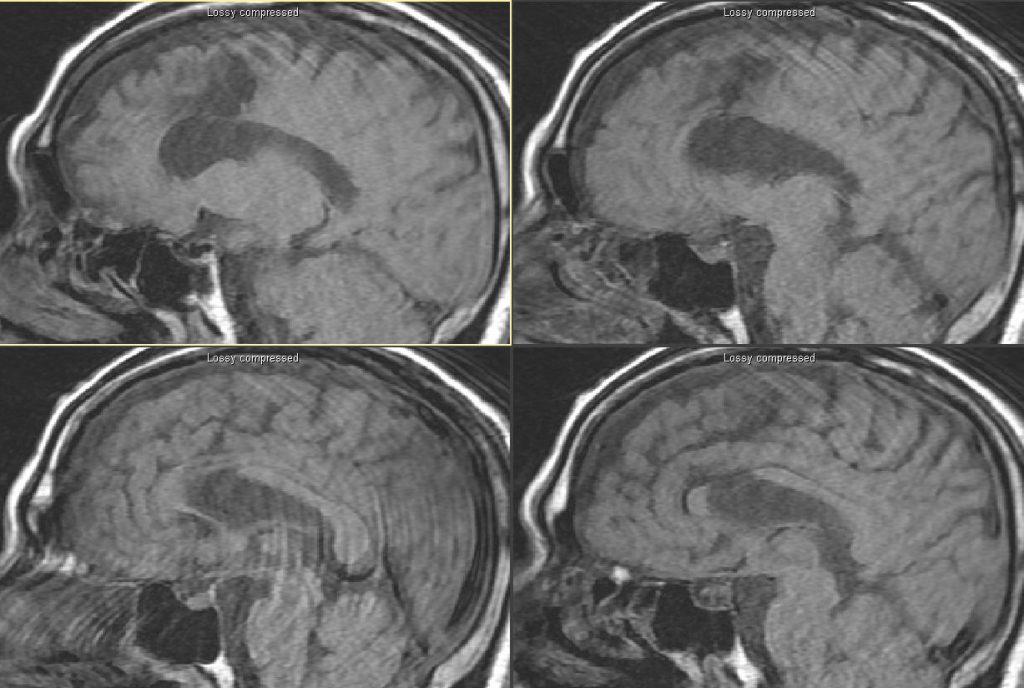 T1 sagittal.