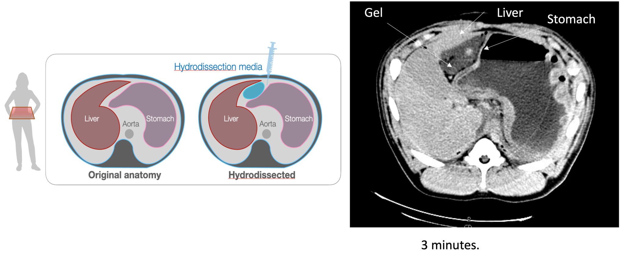 image of Gel-Dissection