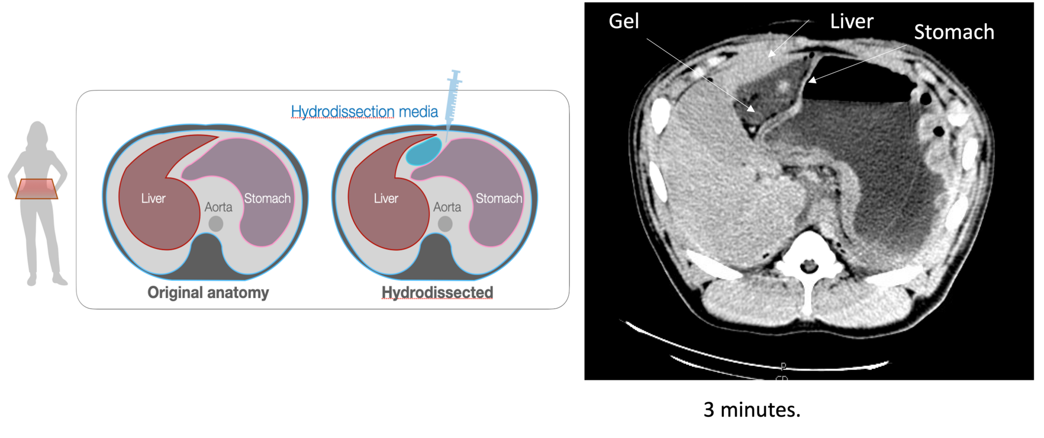 Gel dissection.