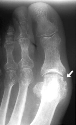 Gout Toe.
