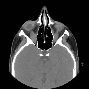 CT noncontrast axial.
